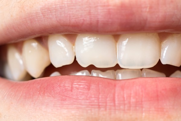 Why It Is Necessary To Repair A Chipped Tooth